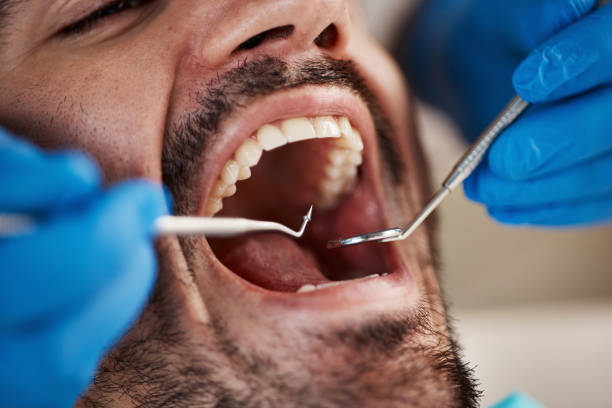 Best Emergency Wisdom Teeth Removal in Red Bay, AL