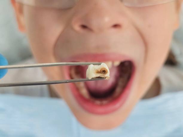 Best Emergency Broken Tooth Repair in Red Bay, AL